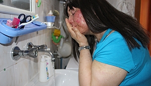 Yaraları iyileşti  yüzünü yıkadı