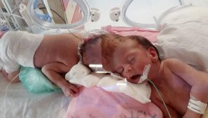 Antalyalı siyam ikizleri, İngiltere'de ayrıldı