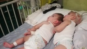 Antalyalı siyam ikizleri, İngiltere'de ayrıldı