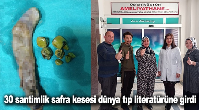 30 santimlik safra kesesi dünya tıp literatürüne girdi