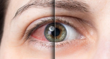 “Mevsimsel alerjiler, en çok gözleri etkiliyor”