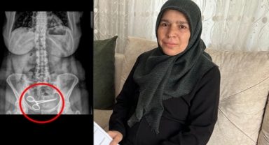 Karnındaki makasla 8 ay yaşadı