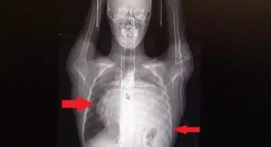 Kalbini 12 santim sağa kaydıran dev tümör doktorlarını bile şaşırttı