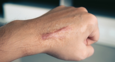 Yanık İzi Nasıl Geçer?