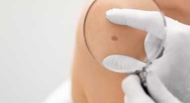 Cilt kanserine neden olan 12 risk faktörü