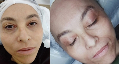 Güzelliğin sırrı Phı-Ion ve Microneedling'te