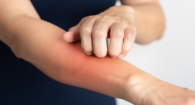 Uyuz insan derisinde ne kadar yaşayabiliyor?