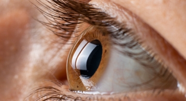 Astigmat nedir?