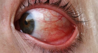 Pterijium ve göz sağlığındaki rolü