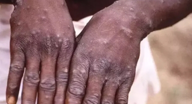 Sağlık Bakanlığı cevapladı: Maymun çiçeği ile ilgili 11 soru